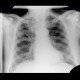 Pulmonary tuberculosis, TBC, tuberculosis: X-ray - Plain radiograph